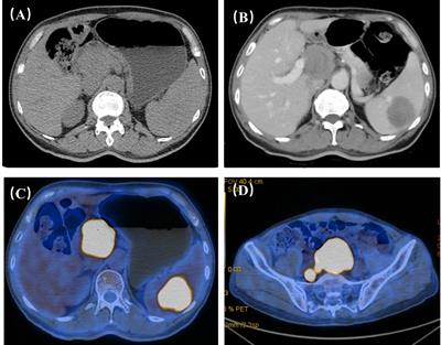 The findings on the CEUS of diffuse large B cell lymphoma in abdomen: A case report and literature review